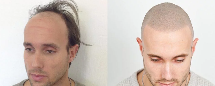 هزینه اسکالپ سر